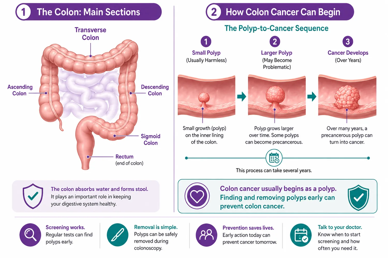 Colon anatomy and the polyp-to-cancer sequence — how colon cancer develops from a polyp over years, in the ascending, transverse, descending and sigmoid colon