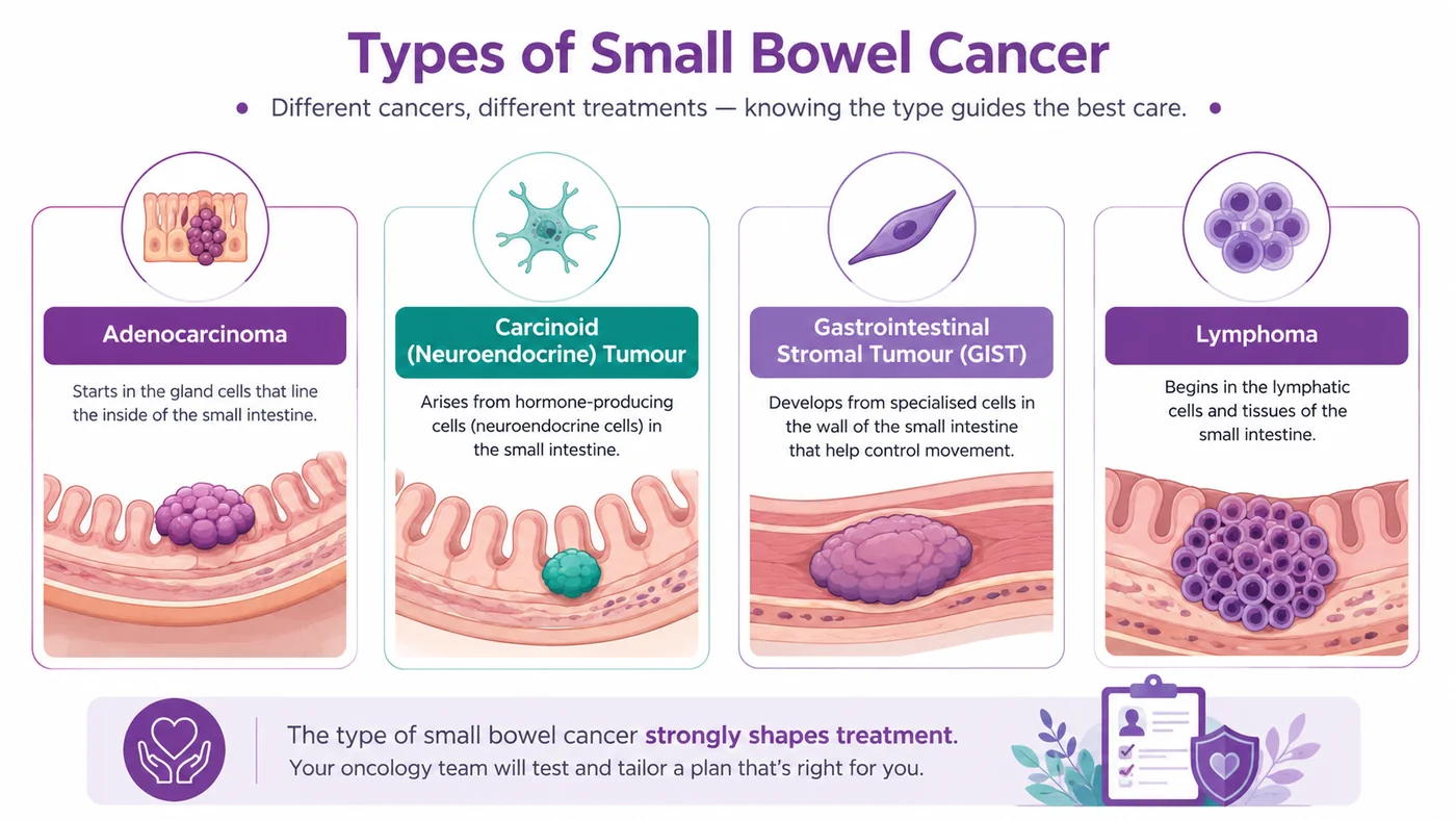 Types of small bowel cancer — adenocarcinoma, carcinoid, GIST and lymphoma