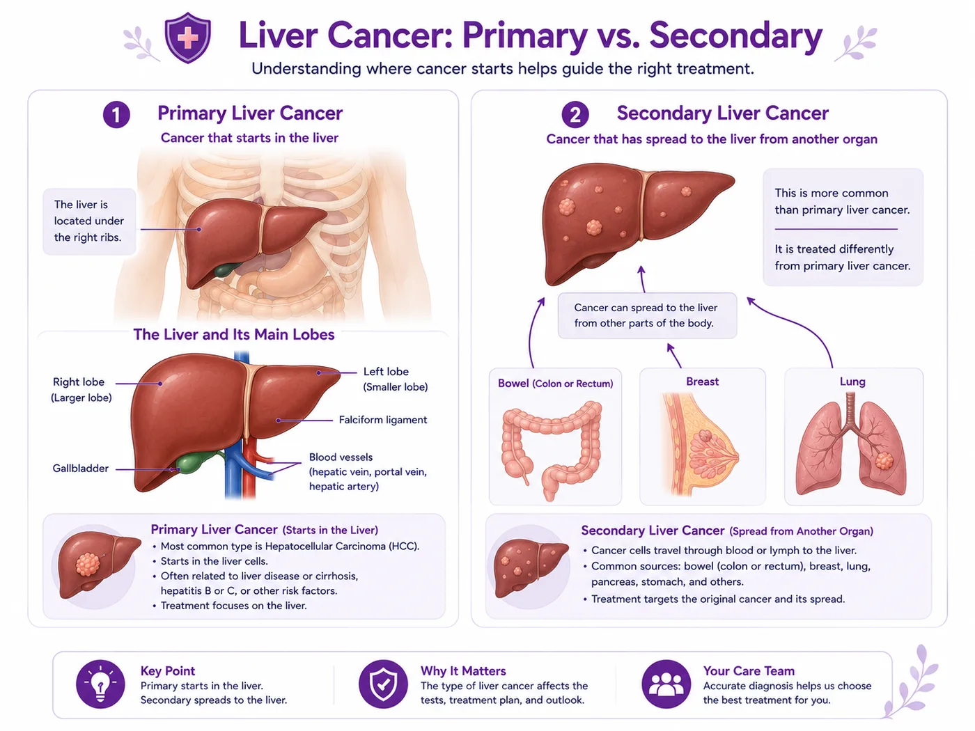 Primary versus secondary liver cancer — primary starts in the liver, secondary spreads to the liver from the bowel, breast or lung and is more common