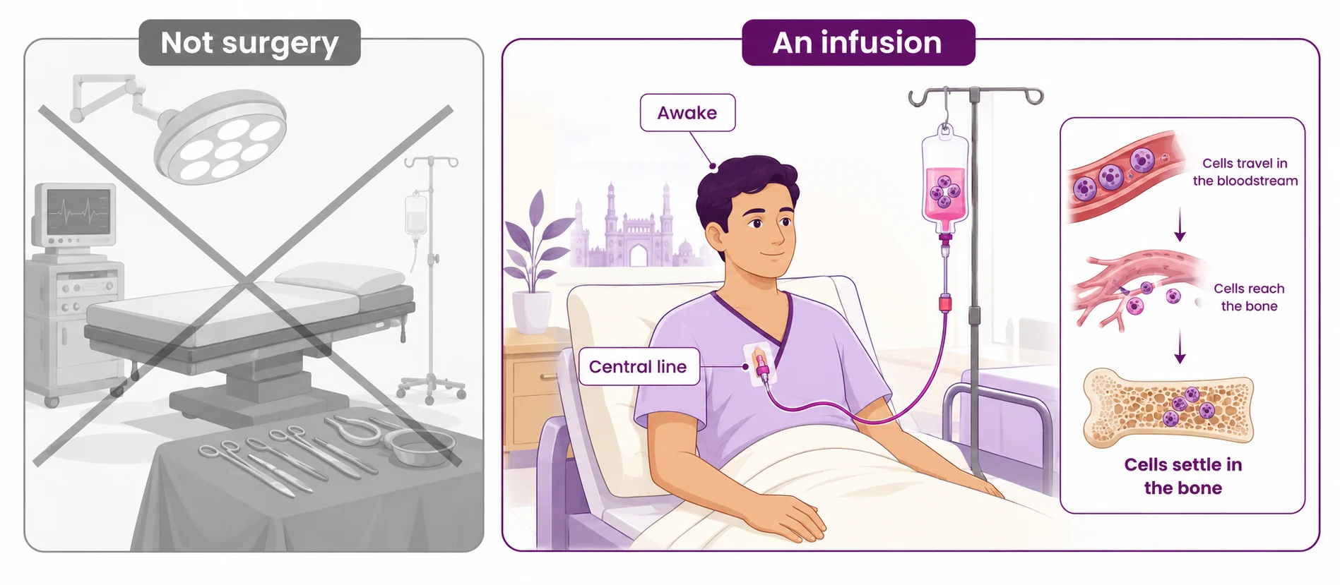 Diagram showing a bone marrow transplant is an infusion through a central line while the patient is awake, not a surgical operation — the cells travel through the bloodstream and settle in the bone — CION Cancer Clinics