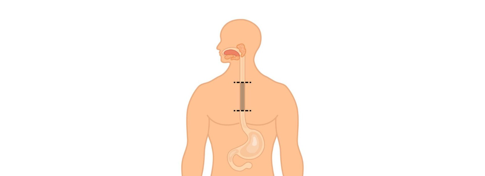Treatment for esophageal cancer