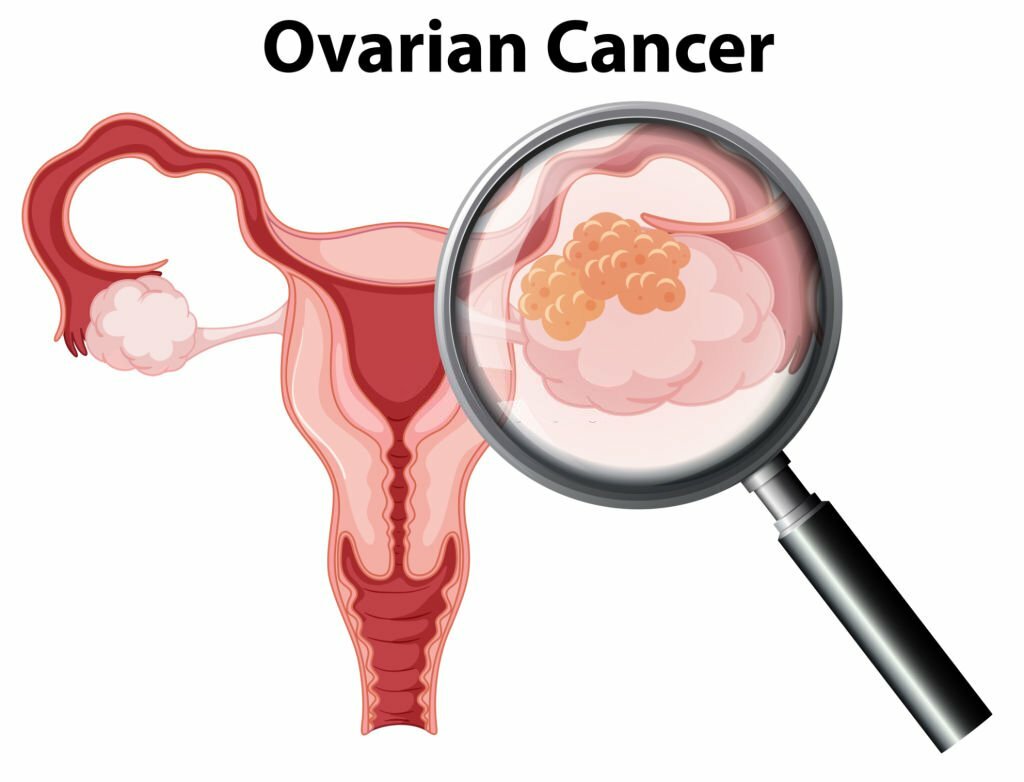 What are the symptoms of ovarian cancer 