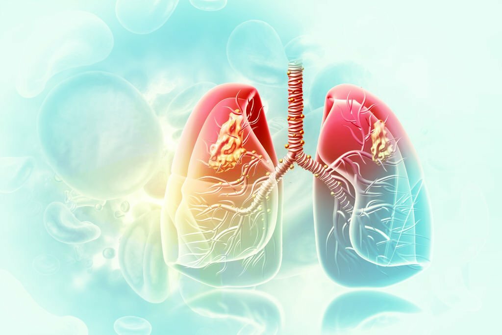 What is lung cancer and what are the symptoms of lung cancer